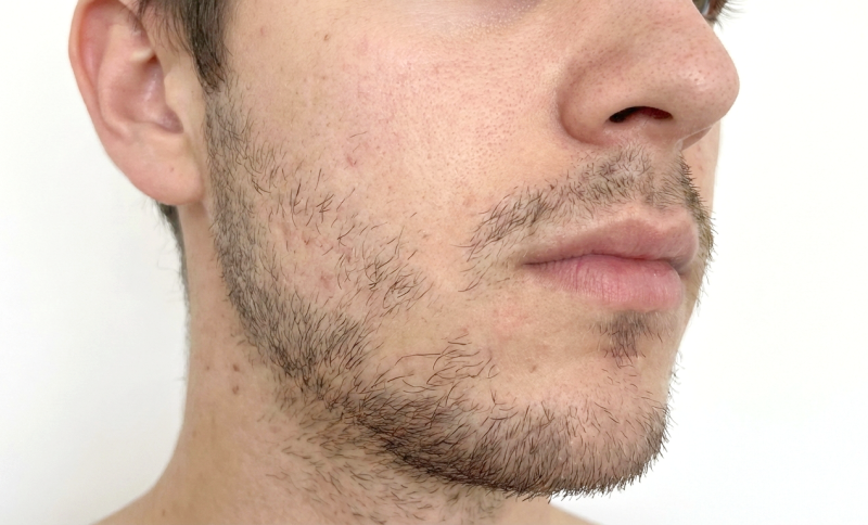 paciente con poca densidad capilar en la barba